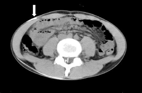 CT scan of the abdomen A patient with a previous LP shunt placement... | Download Scientific Diagram