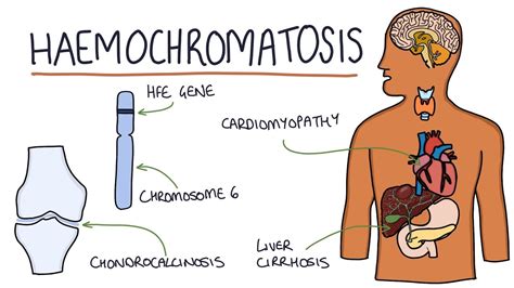 Hemochromatosis Gene