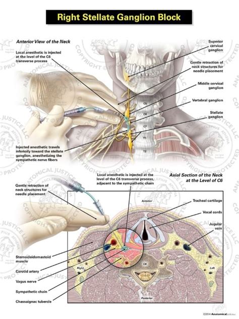 Female Right Axial Stellate Ganglion Block