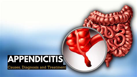 Appendicitis Animation