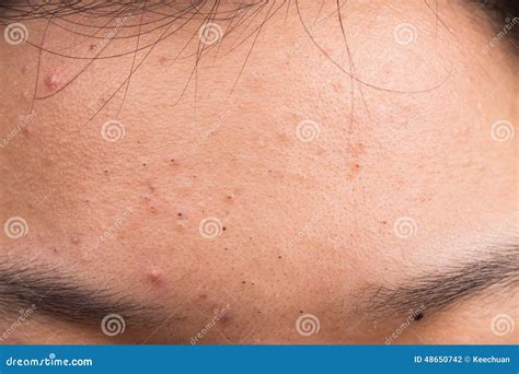 Pimple Blackheads On The Forehead Stock Photo - Image: 48650742