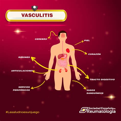 Vasculitis