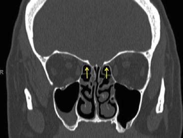 Ethmoid Sinus Surgery | SpringerLink