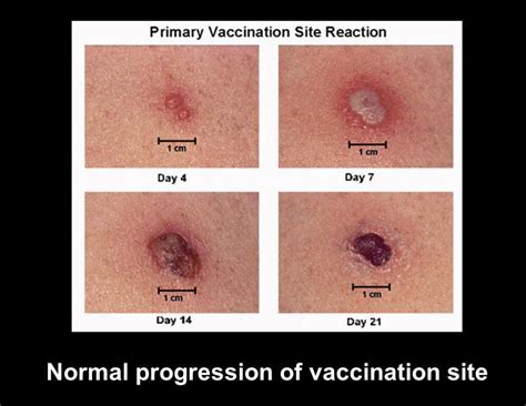 BCG Vaccination | Pakenham Medical Clinic