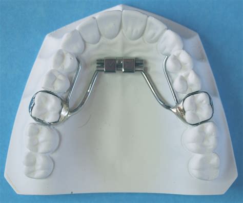 Rapid Palatal Expander - Braces By Henry : Braces By Henry