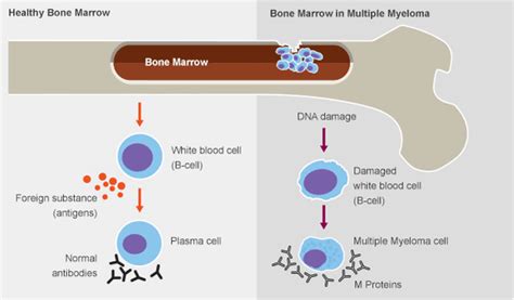 Understanding Multiple Myeloma Symptoms, Signs, and More