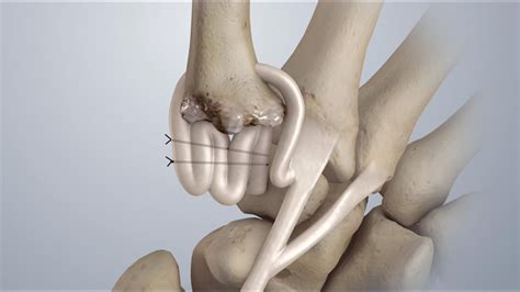 Osteoarthritis of the Thumb: Surgical Treatment (LRTI) - YouTube