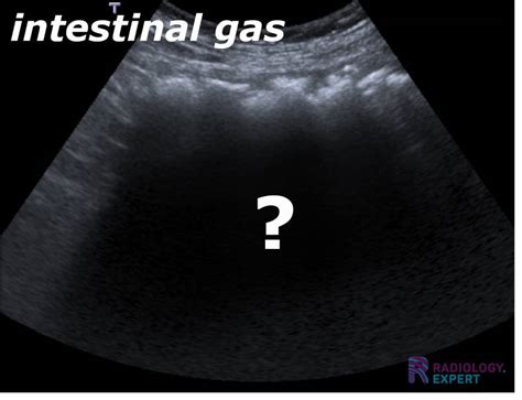 Abdominal ultrasound