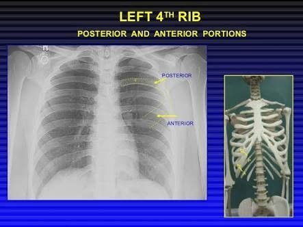 Posterior and Anterior rib on Chest X ray ... Note: Posterior rib is ...