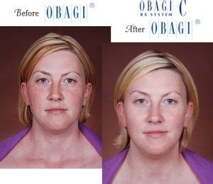 Obagi® Before and After Pictures – Micki Ly M.D. Maui Dermatologist