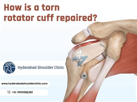 Do And Don'ts After Rotator Cuff Surgery