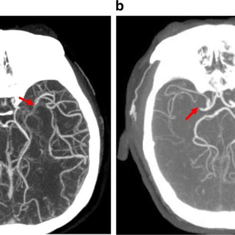 Middle cerebral artery occlusion and collateral circulation. Computed... | Download Scientific ...