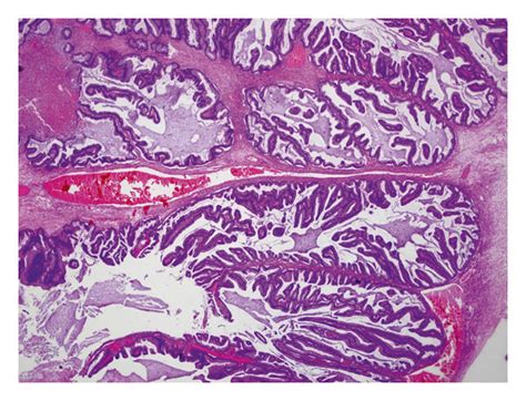 Borderline mucinous tumor of the ovary (intestinal type; HE 20x ...