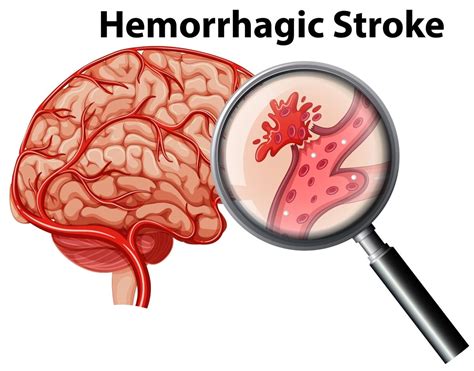 What Are the Causes of Hemorrhagic Stroke? - Harris Lowry Manton LLP