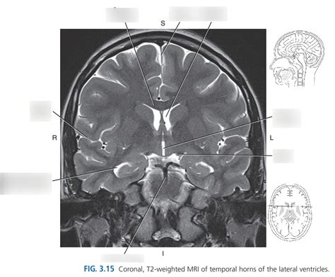 CORONAL MRI TEMPORAL HORNS LATERAL VENTRICLES Diagram | Quizlet