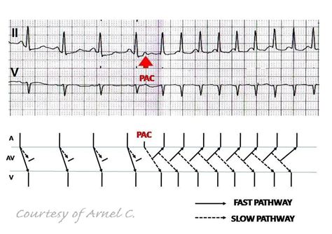 ECG Rhythms: Atrial Arrhythmia Triggering AVNRT