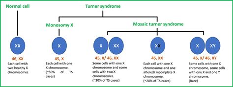 Turner Syndrome Diagram