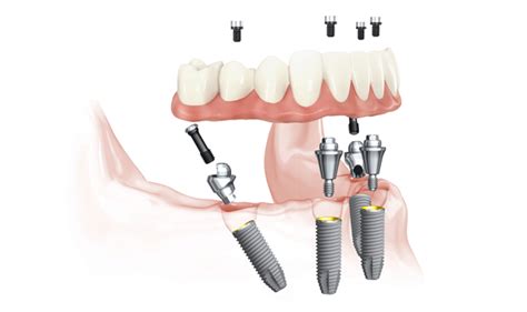 Nobel Biocare's Trefoil™ – The next full-arch revolution - iData Research