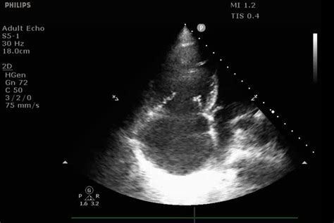 Differentiating Acute Versus Chronic Right Heart Failure with Bedside Echocardiography EMRA