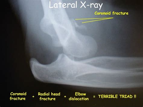 Terrible Triad of Elbow