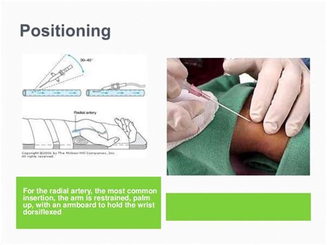 Arterial line insertion