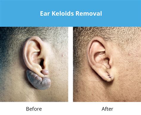 Earlobe Repair | Keloids on Ears | Venice, Sarasota