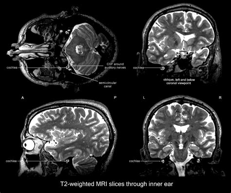 Cochlea on MRI! | Pharmacology nursing, Audiology, Pharmacology