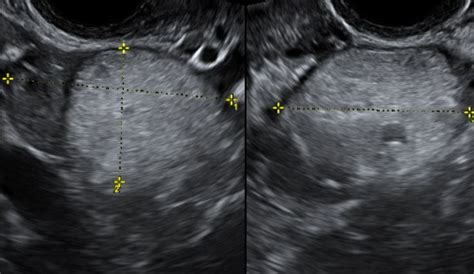 Ovarian Dermoid | Medical ultrasound, Ultrasound technician, Ultrasound