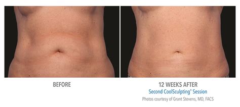 CoolSculpting Stomach Fat Before and After Photos