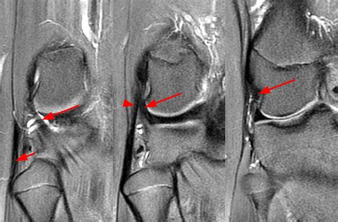 Pathology of the Popliteus Tendon | Radsource