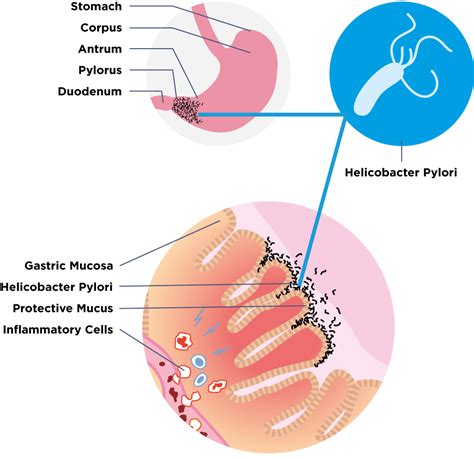 Helicobacter pylori - Guts UK