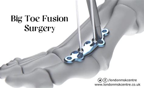 Big Toe Fusion Surgery Form of Treatment Big Toe Joint: LondonMSKCentre.co.uk