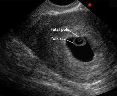 [Figure, Normal gestational sac Image courtesy S Bhimji MD] - StatPearls - NCBI Bookshelf