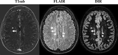 Non-Contrast MRI is Effective in Monitoring MS Patients