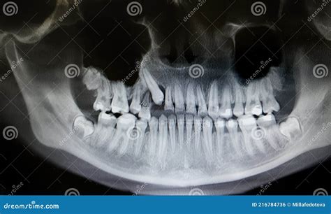 Dental X-ray with Braces. Orthopantomography, OPG X-ray DR Digital for ...