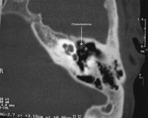 Cholesteatoma Ct Scan Images Clinic