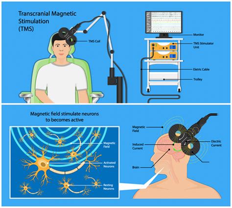 TMS Clinic | Transcranial Magnetic Stimulation Therapy