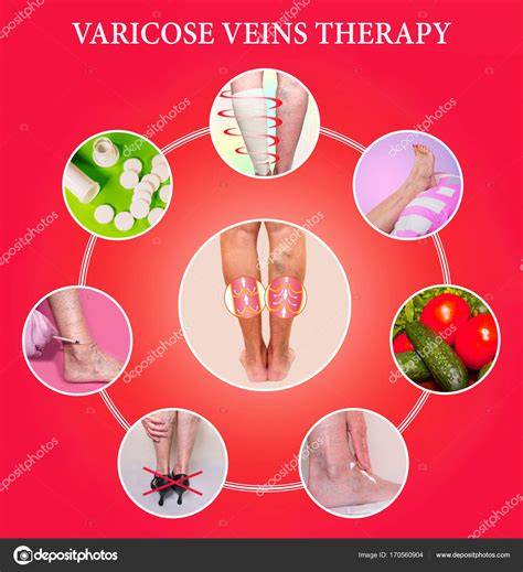 Treatment of varicose veins — Stock Photo © Marina113 #170560904