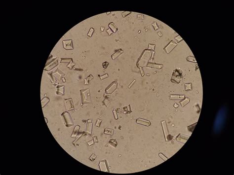 Magnesium ammonium phosphate crystals in urine (and large amounts of leukocytes and bacteria ...