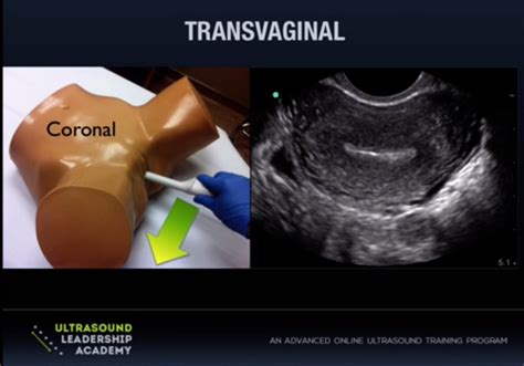 Uterus Ultrasound Transvaginal