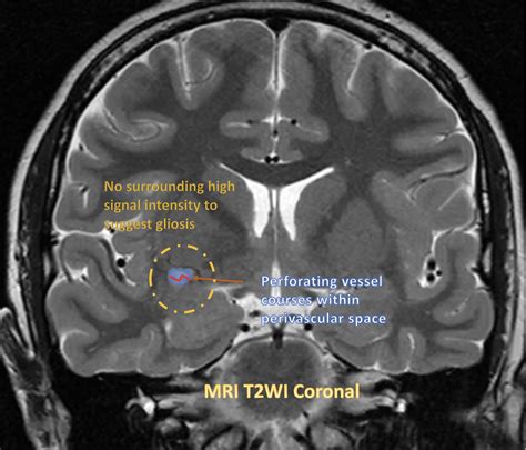 Perivascular space | Image | Radiopaedia.org