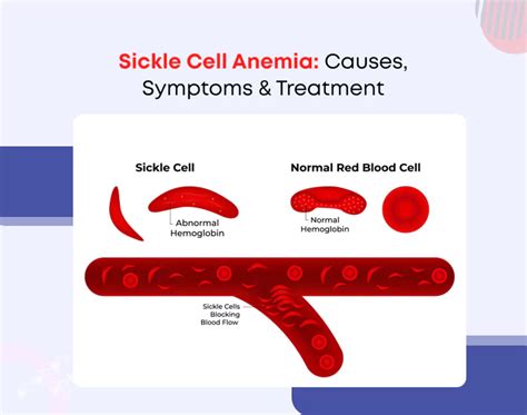 Sickle Cell Anemia: Causes, Symptoms & Treatment