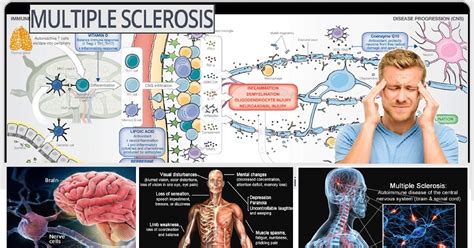 Multiple sclerosis ; Causes and Treatment