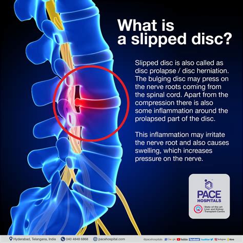 Slipped Disc Symptoms, Causes and Treatment | Disc Prolapse