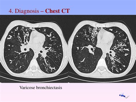 PPT - Clinical manifestation and diagnosis of bronchiectasis Aleš Rozman University Clinic of ...