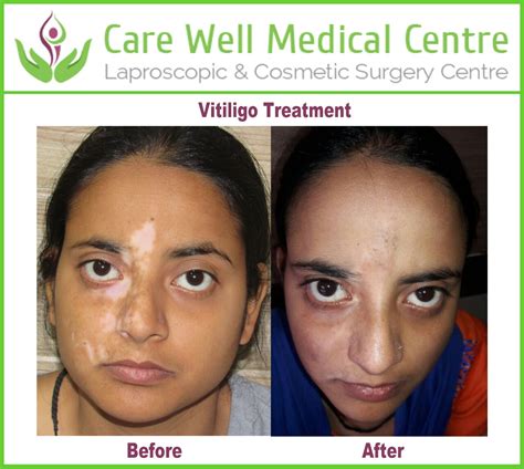 Vitiligo Treatments in Delhi - Vitiligo Surgery in Delhi, India and ...