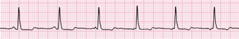 What Is A Wandering Atrial Pacemaker With Pictures | Images and Photos ...