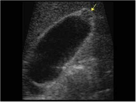 Abdomen and retroperitoneum | 1.2 Gallbladder and bile ducts : Case 1.2.10 Gallbladder ...