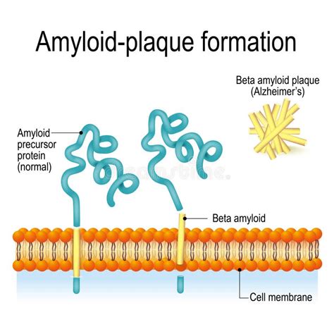 Amyloid-plaque Formation. Alzheimer`s Disease Stock Vector - Illustration of integral, health ...