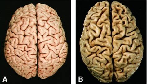 Neurology Today